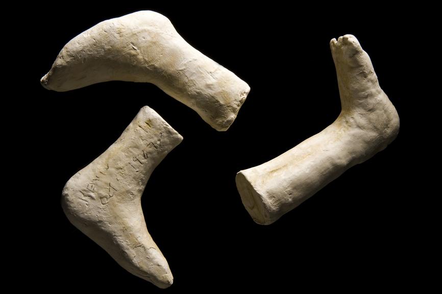 Plaster casts of a child patient's feet, Hampshire, England, 1967