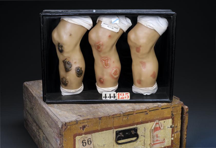 Three wax legs showing treatment of ulcers caused by syphilis, Germany, 1910-1920