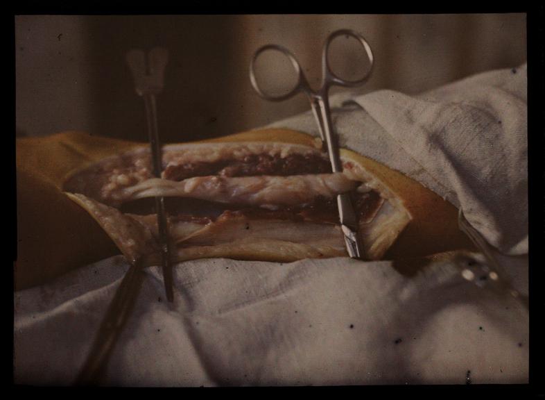 Surgical procedure showing tendons, c.1910