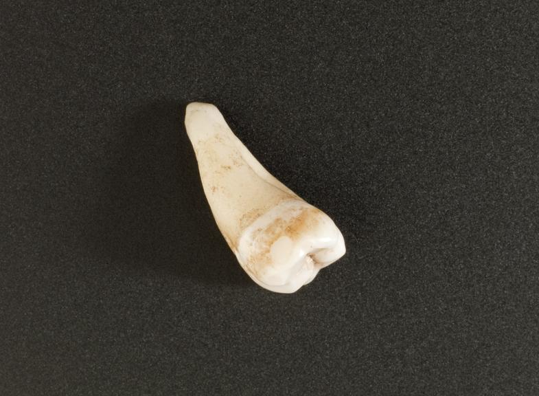 3 human molar teeth