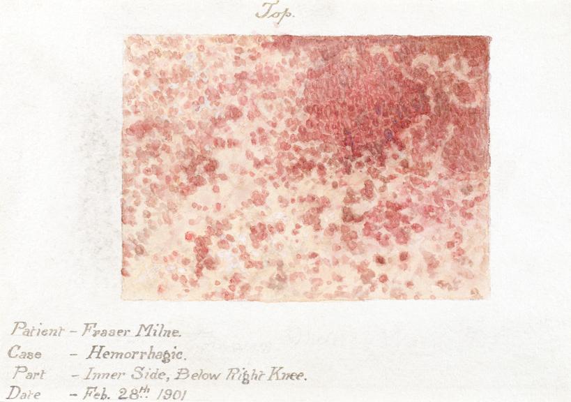 Watercolour illustration of a hemorrhagic skin disease