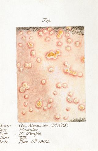 Watercolour illustration of a pustular skin disease