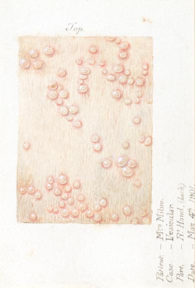 Watercolour illustration of a vesicular skin disease