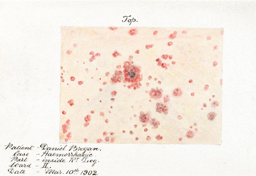 Watercolour illustration of a hemorrhagic skin disease, patient