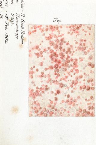 Watercolour illustration of a hemorrhagic skin disease.