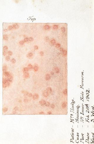 Watercolour illustration of a staining skin disease