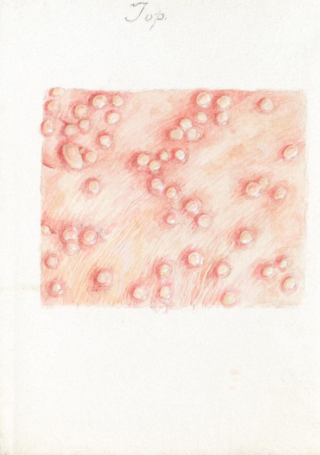 Collection of 15 watercolour illustrations of pox lesions in human skin ...