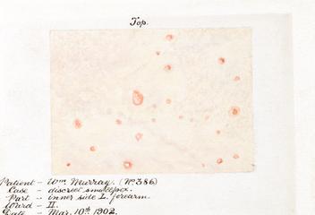 Watercolour illustration of smallpox