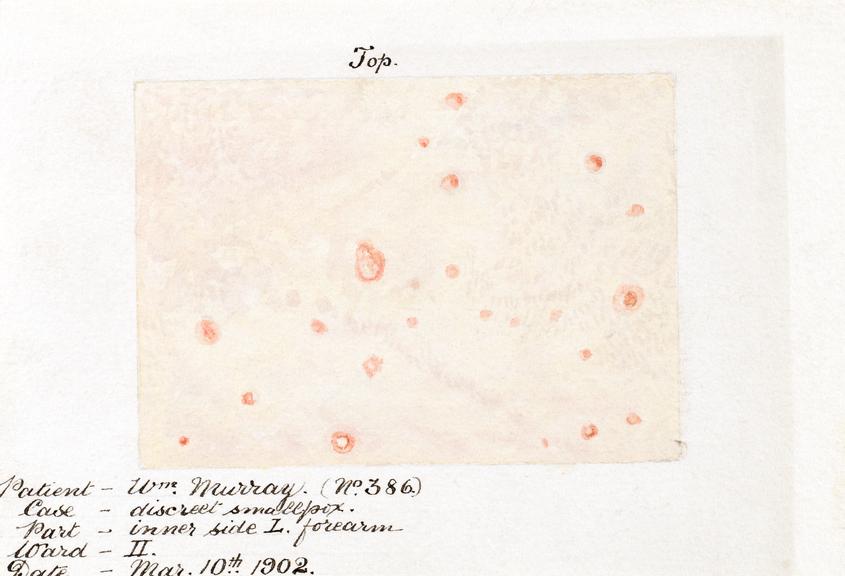 Watercolour illustration of smallpox