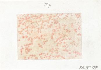 Watercolour illustration of a skin disease