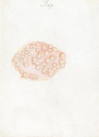 Watercolour illustration of a skin disease