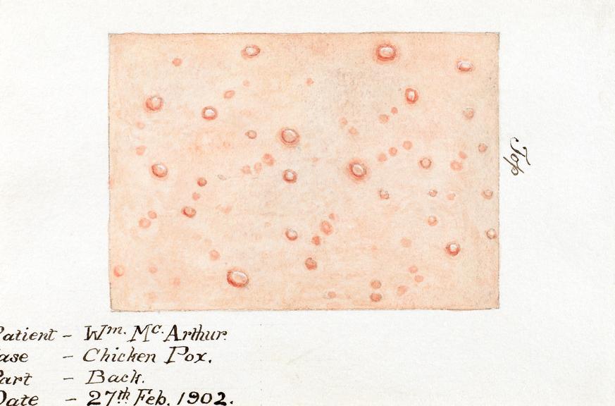 Collection of 15 watercolour illustrations of pox lesions in