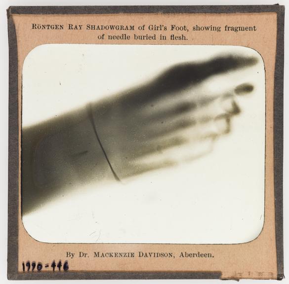 Collection of 3 1/4" glass slides of radiographs