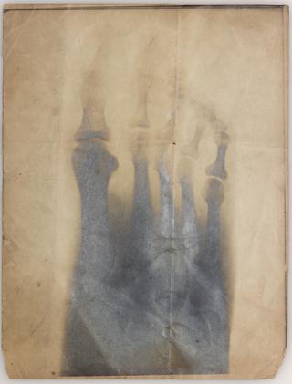 Foot x-ray photograph by George Hugh Gabb