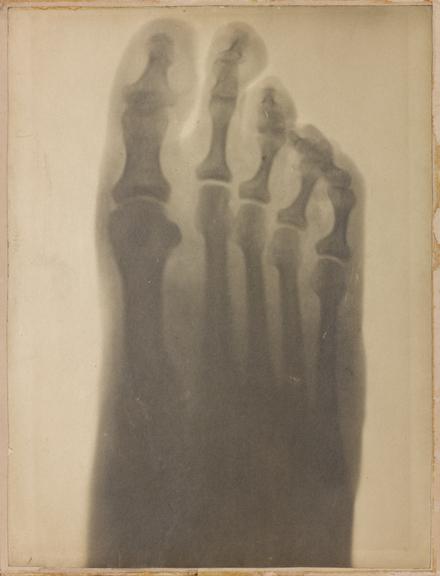 Early x-ray photographs taken by G. H. Gabb, 15 February 1896.