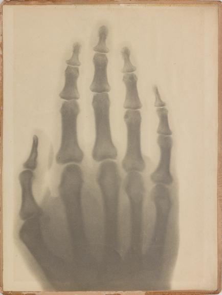 Early x-ray photographs taken by G. H. Gabb, 15 February 1896.