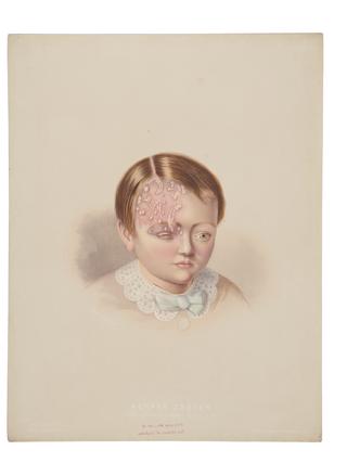 Atlas Of Portraits Of Diseases Of The Skin | Science Museum Group ...