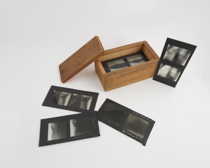 Seventeen x-ray stereoscopic transparencies, 1914-1917.