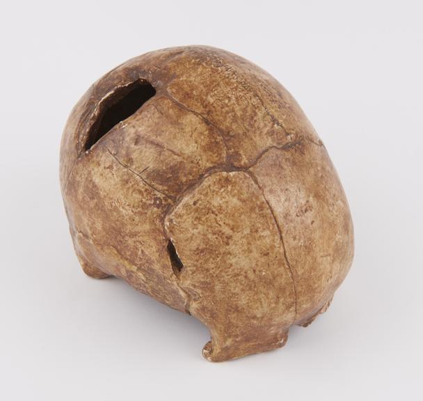 Plaster cast of human cranium showing ancient trephination hole