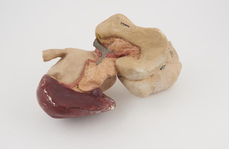 Coloured plaster model of woman's stomach showing effects of