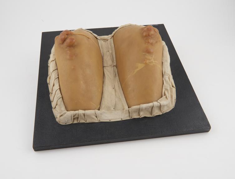 Wax anatomical model of elbows, showing Xanthomata tuberosa