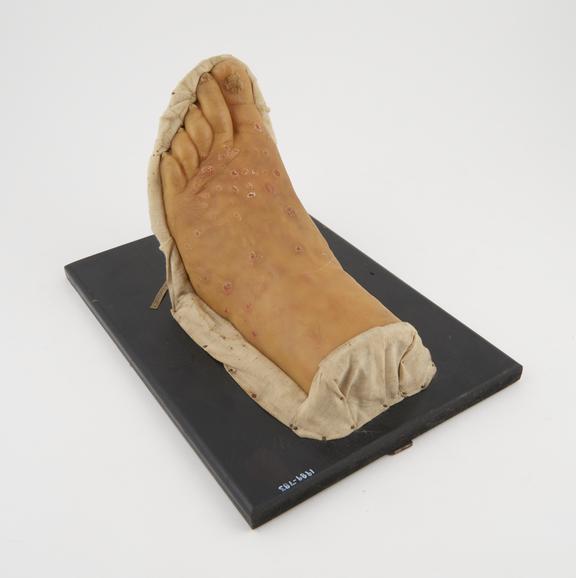 Wax anatomical model of human foot showing Prurigo nodularis