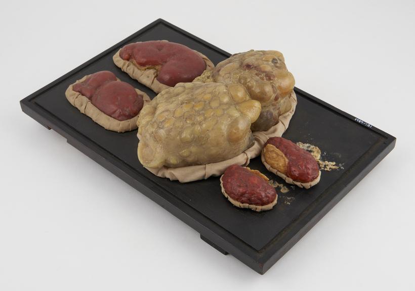 Wax anatomical model of diseased human kidneys, on wooden base