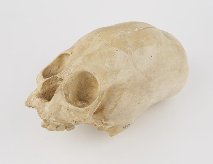 Plaster cast of human skull with artificial cranial deformation