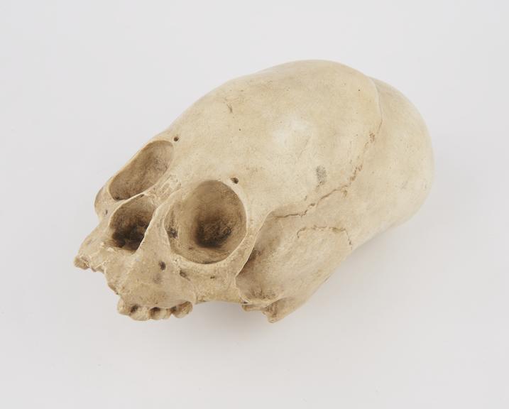 Plaster cast of skull deformed by circular constriction