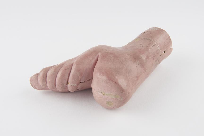 Plaster cast of a female foot, which has been bound from birth