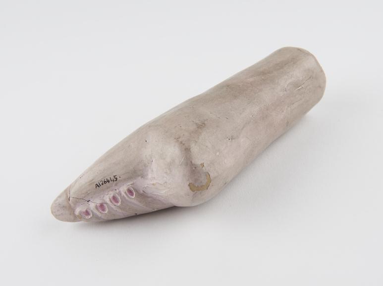 Plaster cast of deformed Chinese lady's foot