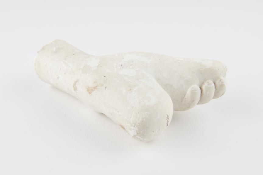 Plaster cast of deformed foot