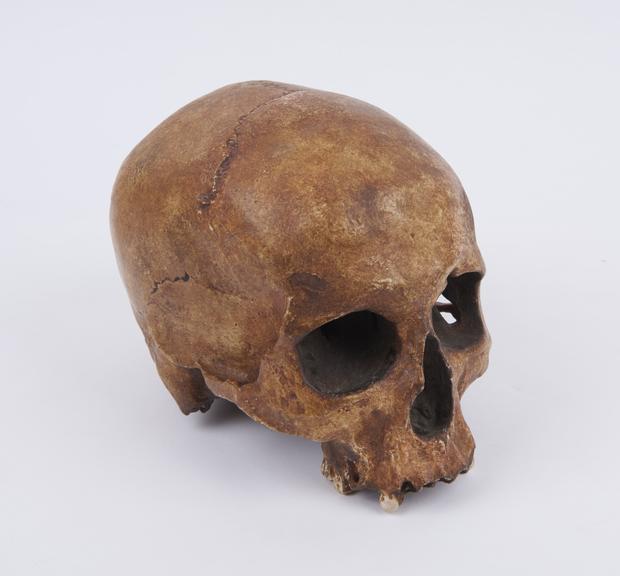 Plaster cast of human cranium showing rectangular trephination