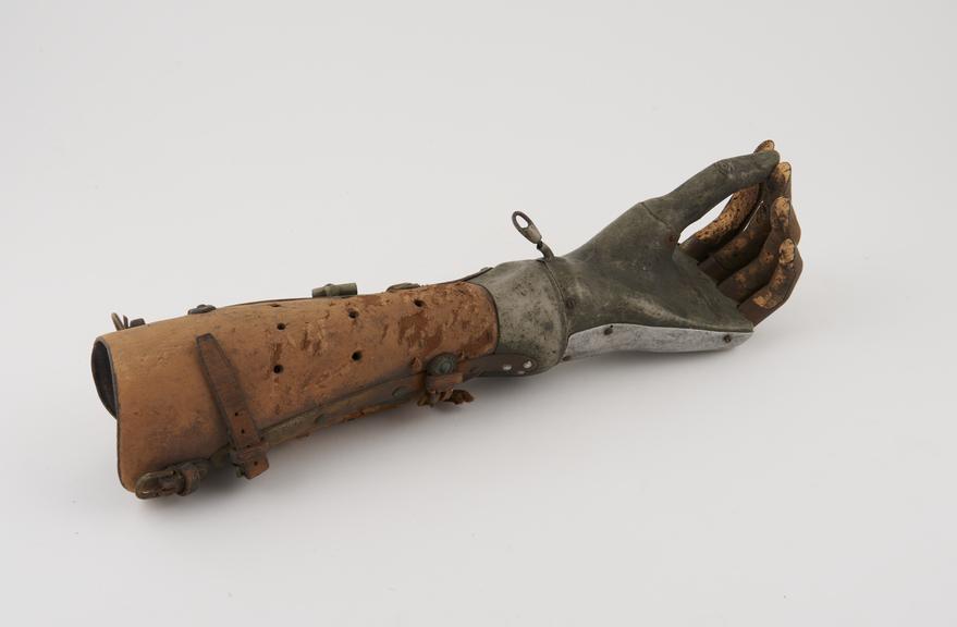 Left 'through-wrist' prosthesis with a Cauet mechanical hand