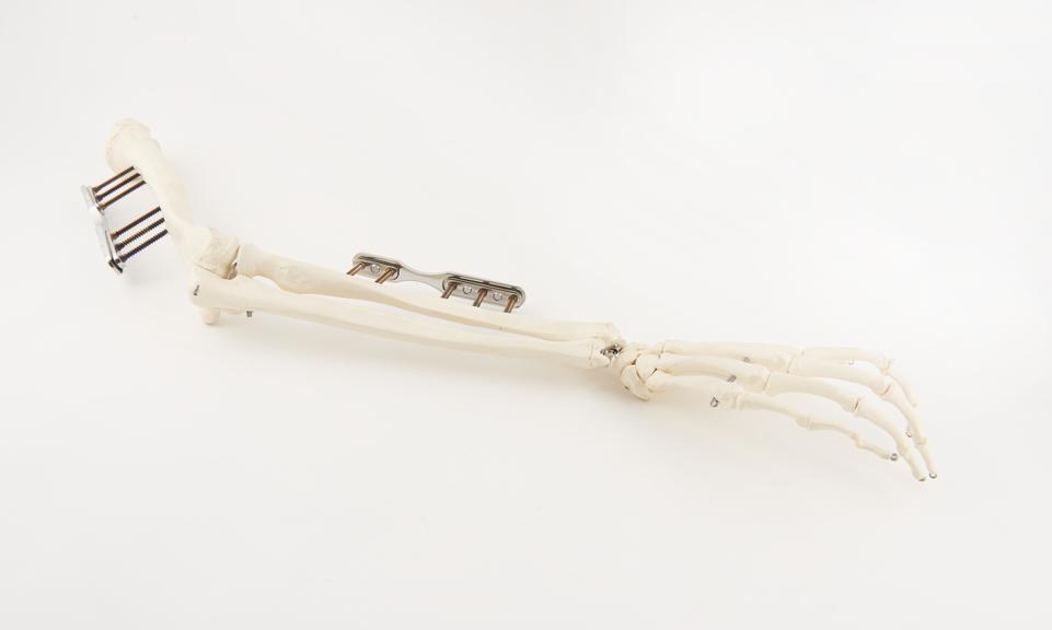 Skeletal arm showing diamond coated steel pins stabilising