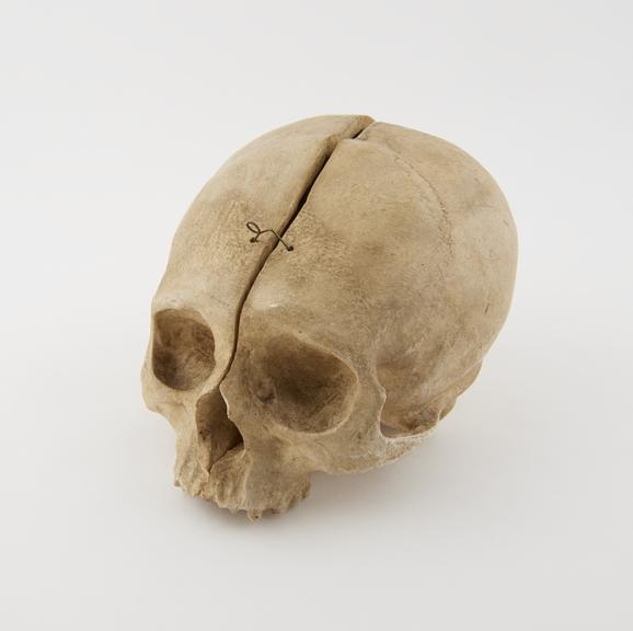 Plaster cast of human skull, in 2 sections attached  by wire