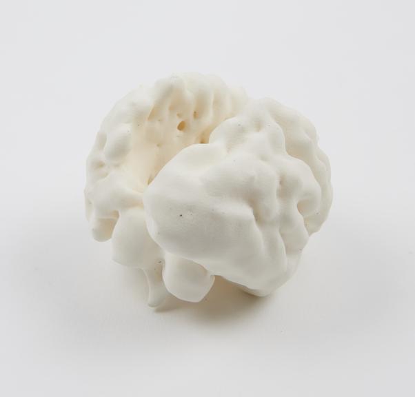 3D printed model of an abnormal fetal brain showing agenesis of