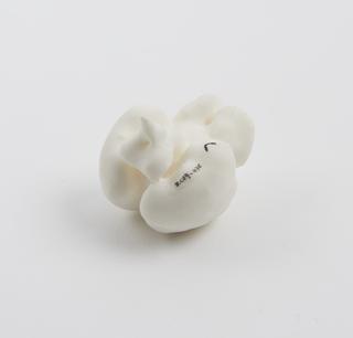 3D printed model of a fetal brain showing semilobar holoprosencephaly at 21 weeks gestation
