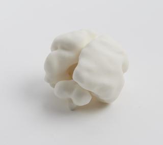 3D printed model of fetal brain showing focal megalencephaly at 26 weeks gestation