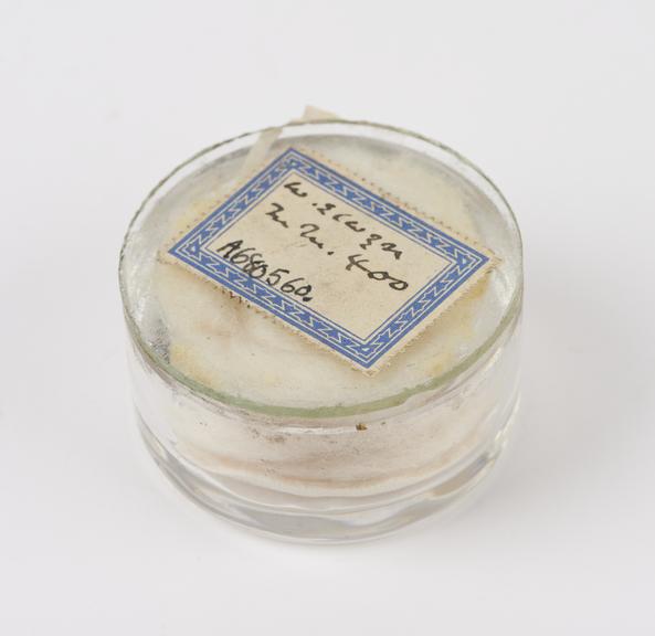 Foreign body, in glass specimen jar, removed from eye of W.E