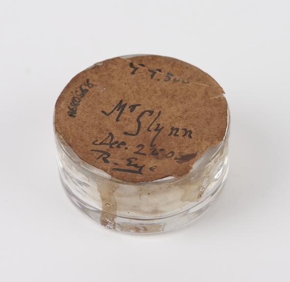 Foreign body, in glass specimen jar