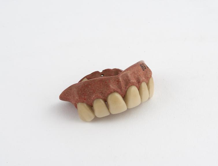 Partial upper denture, anterior section