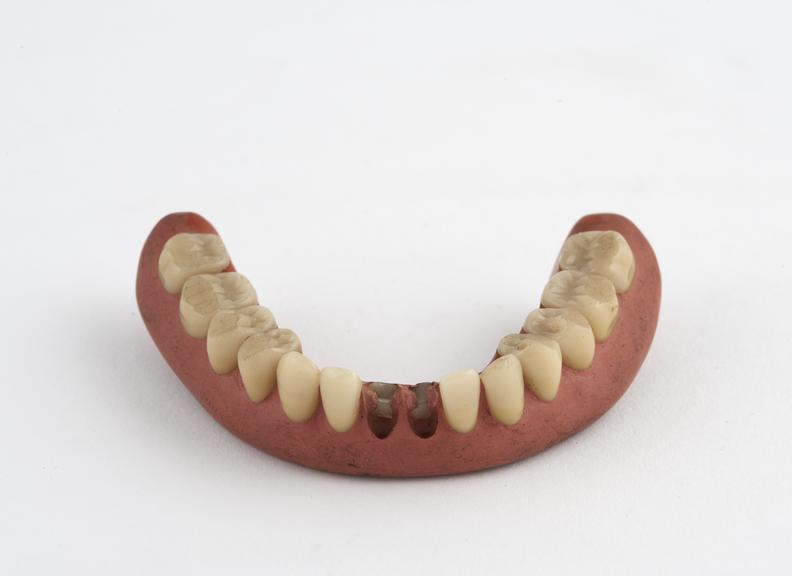 Full lower denture, vulcanite with porcelain diatoric teeth