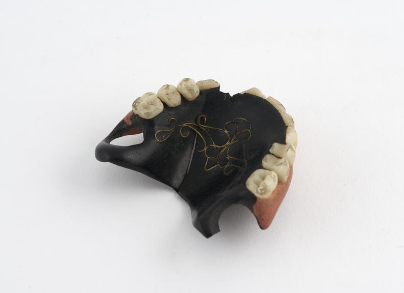 denture