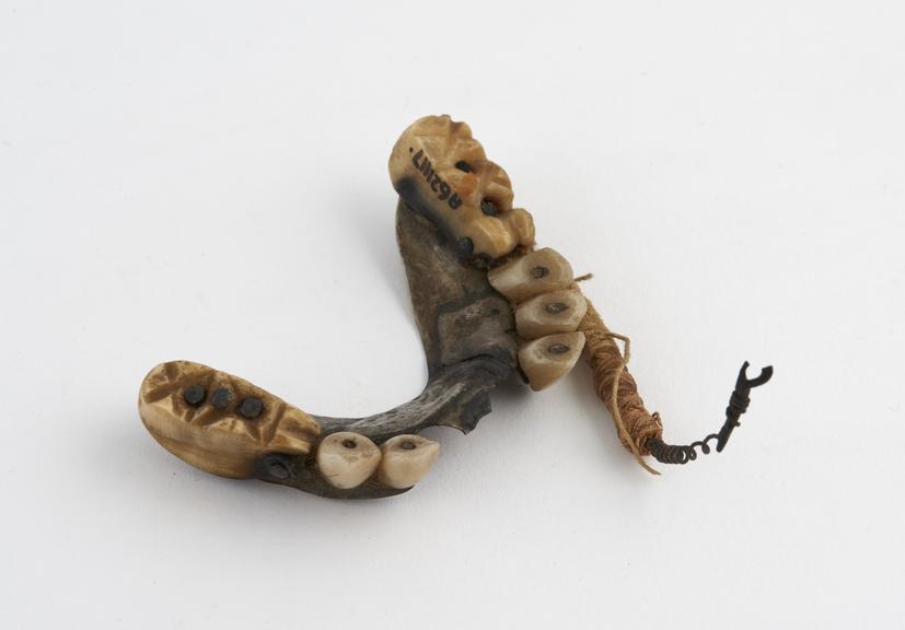 Partial upper denture, swaged alloy plate