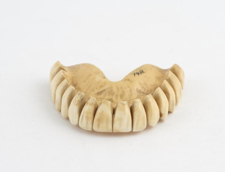 Full upper denture