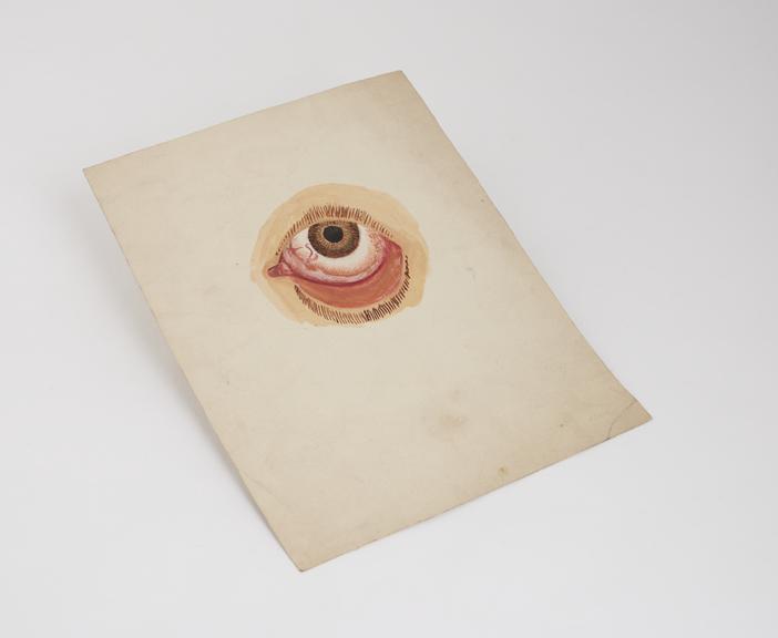 Watercolour illustration of bloodshot eye with drooping lower