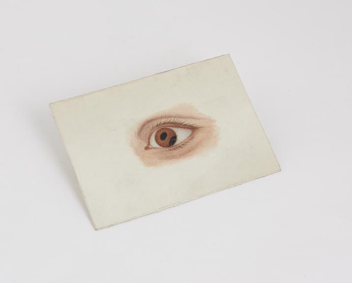 Watercolour illustration, on card of diseased eye, English