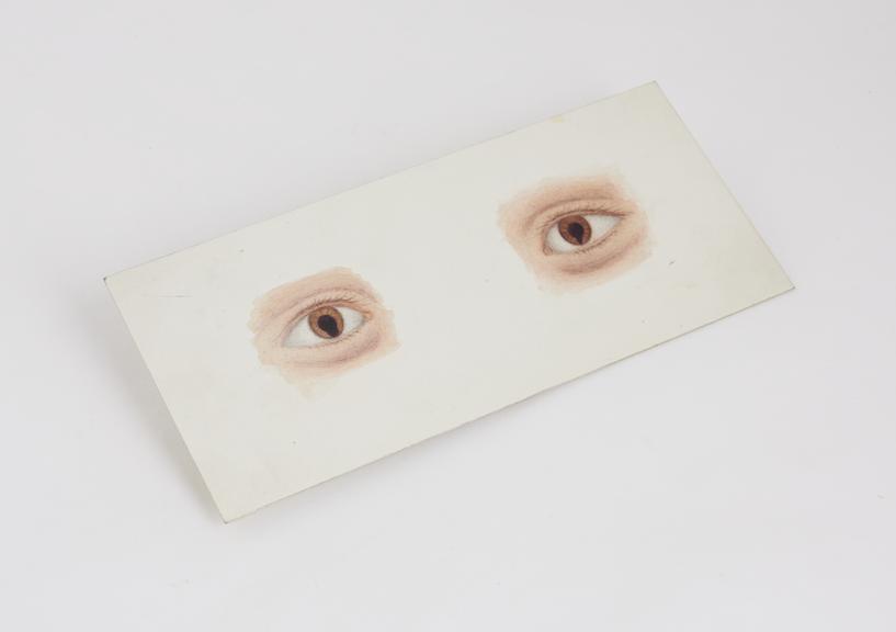 Watercolour illustration on card of Coloboma of Irides