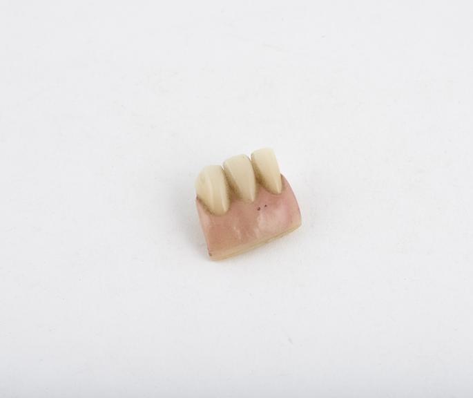 False tooth, block of 3 gum section lower anteriors